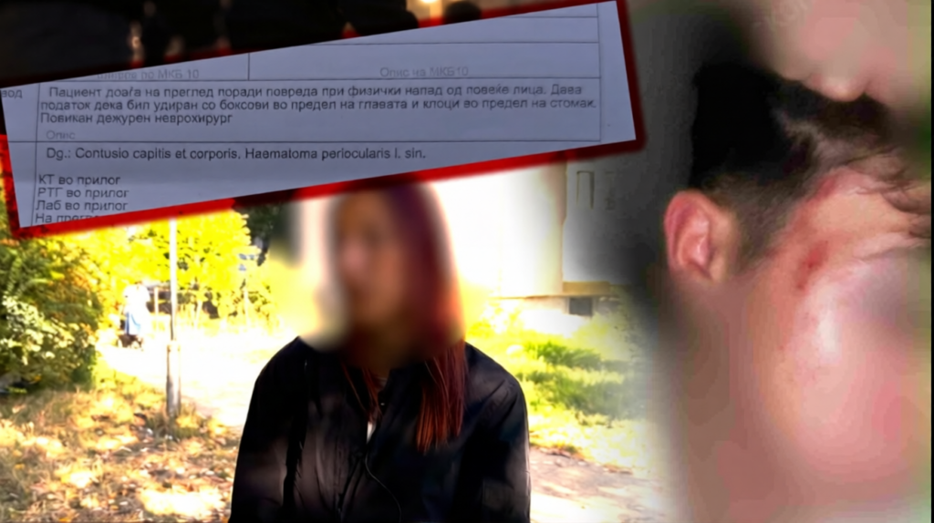 Tmerr në Shkup: Rreth 15 të mitur rrahin brutalisht 13-vjeçarin me sende metalike, ia thyejnë dhembet!